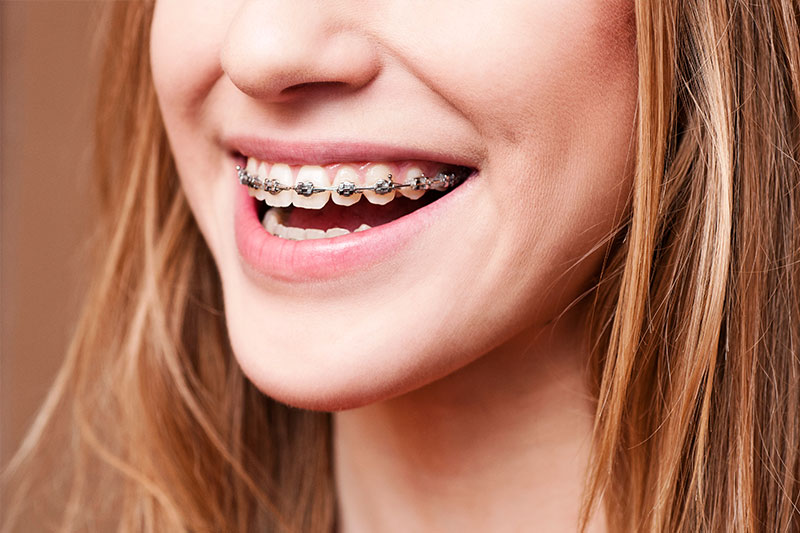 Orthodontics in Cerritos