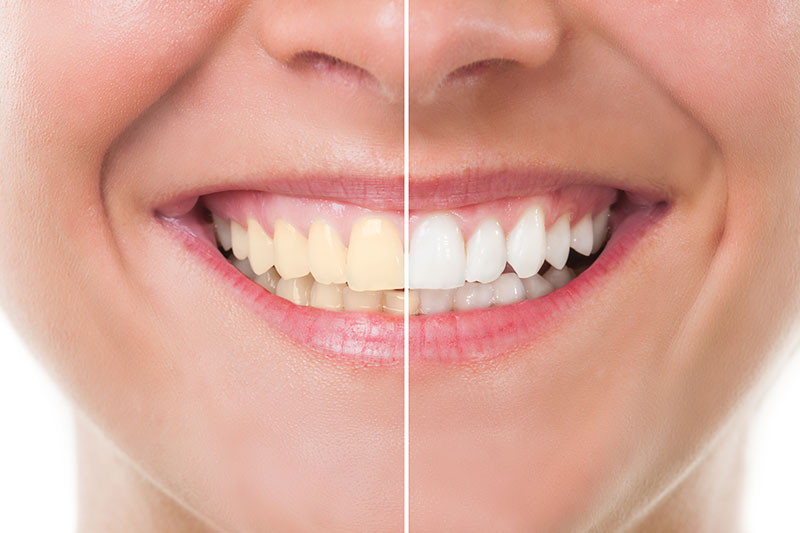 Teeth Whitening in Cerritos